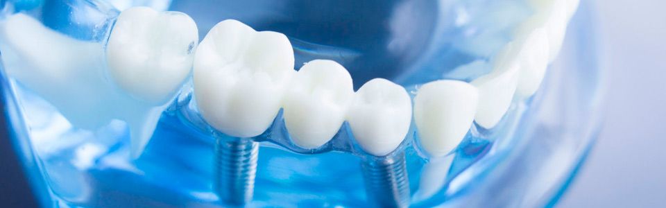 Clínica Dental Virgen del Rocío Implantes dentales